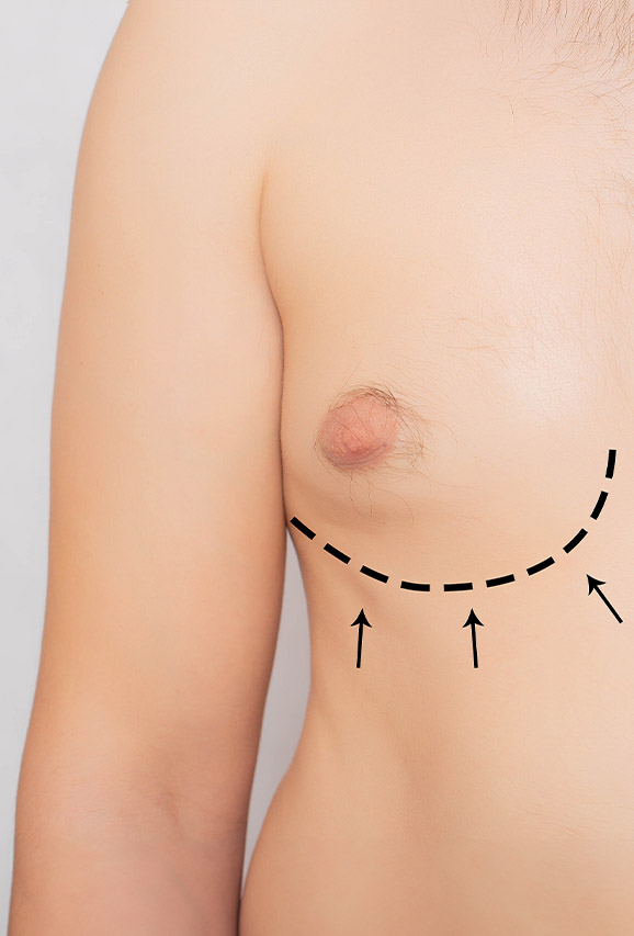 Photo of markings under a man's breast for gynecomastia surgery