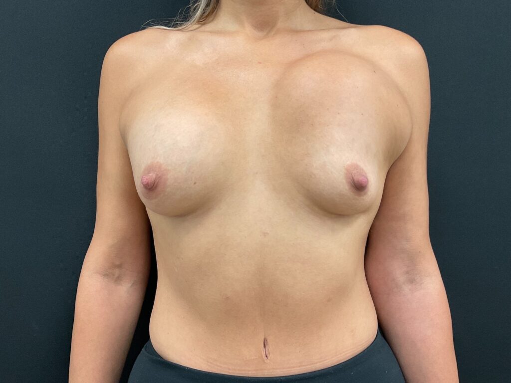 Before photos for breast revision candidate in case study 1