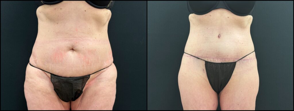 Before and after body lift results