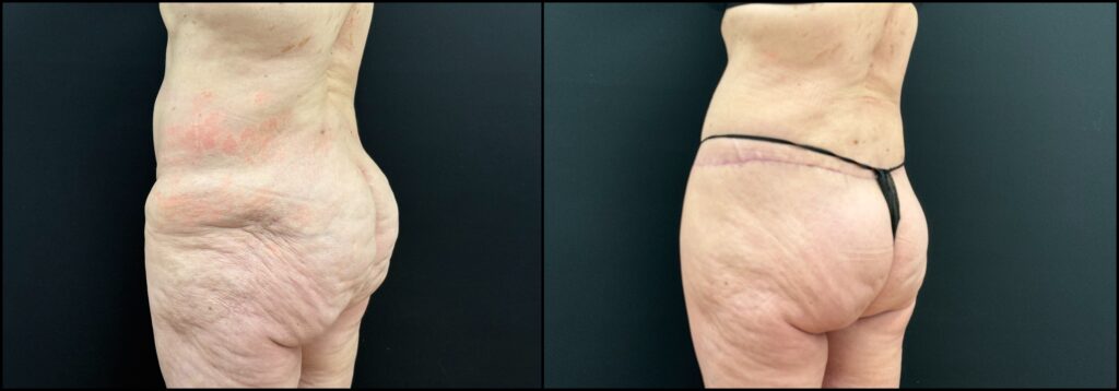 Before and after body lift results